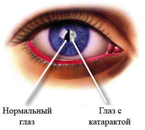 Осложненная катаракта - что это такое?